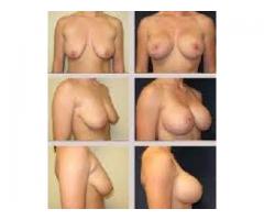 HIPS AND BUMS ENLARGEMENT CREAMS AND PILLS BREAST FIRMING STRECTH MARKS REMOVAL  +27785167256