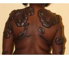 WORKING MORINGA HERBAL KELOIDS SCAR REMOVAL OIL +27717813089 GRAHAMSTOWN, BHISHO, ALICE